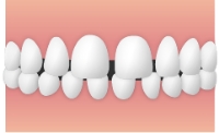 空隙歯列